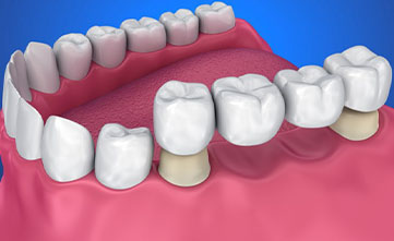 Treatment - Bristol Dental Suite